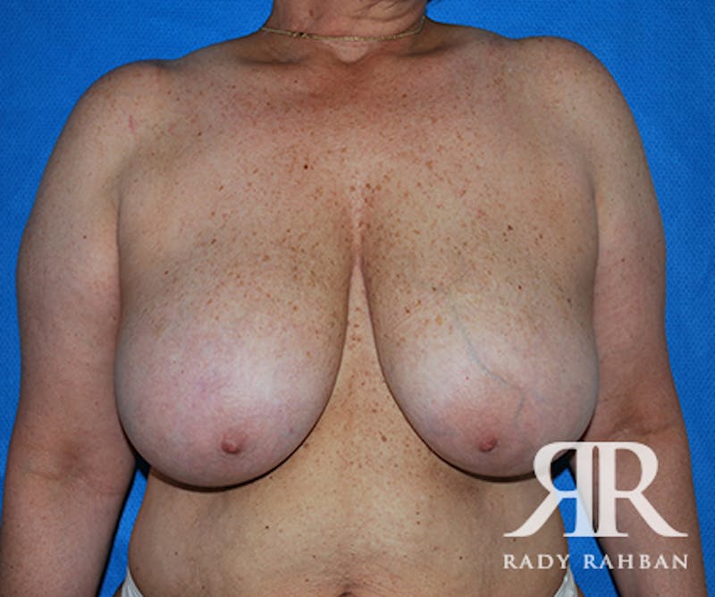 Breast Reduction before photo