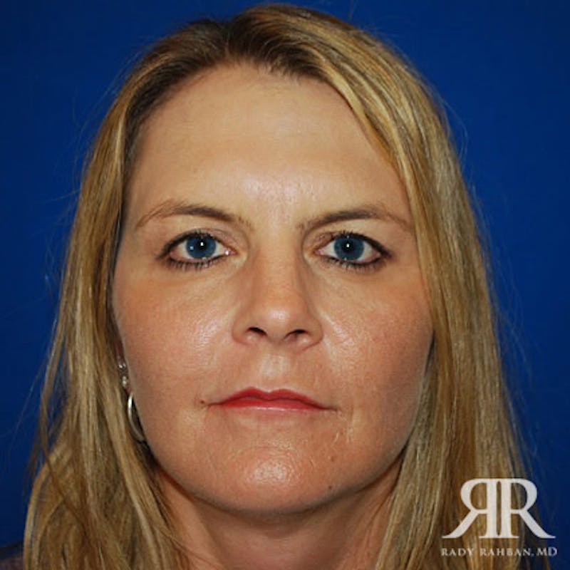 Facelift result at Dr. Rady Rahban