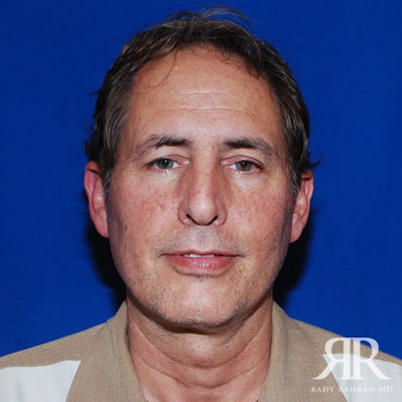 Facelift before photo