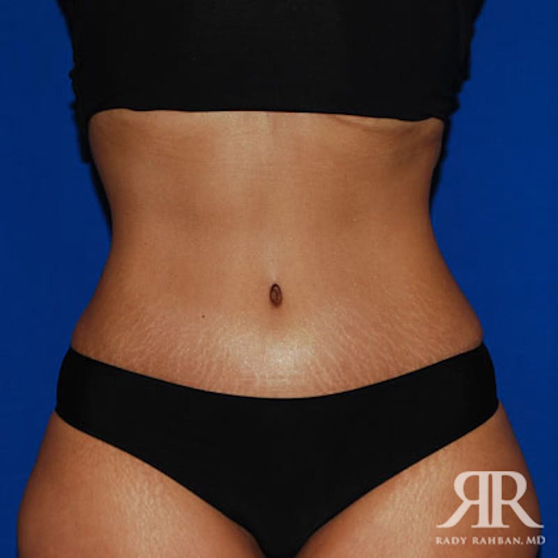 Tummy Tuck result at Dr. Rady Rahban