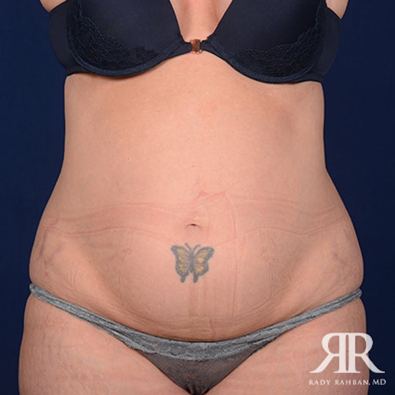 Tummy Tuck before photo
