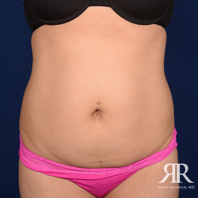 Tummy Tuck before photo