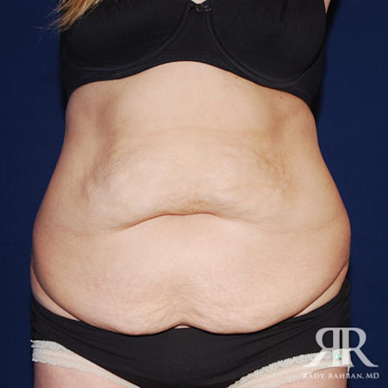 Tummy Tuck before photo