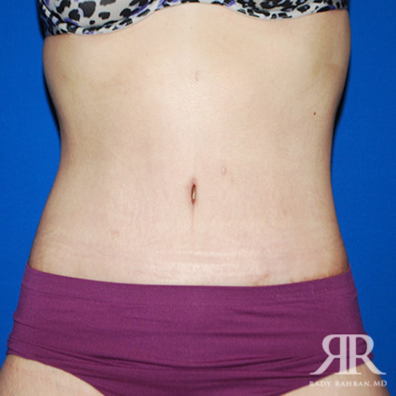Tummy Tuck result at Dr. Rady Rahban