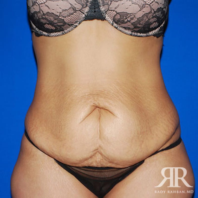 Tummy Tuck before photo