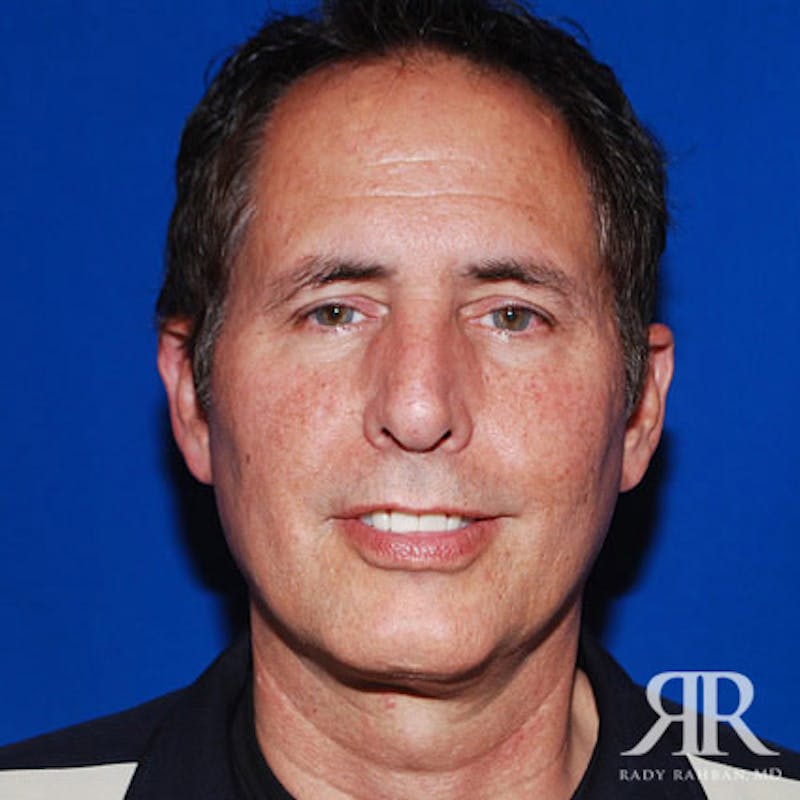 Facelift result at Dr. Rady Rahban