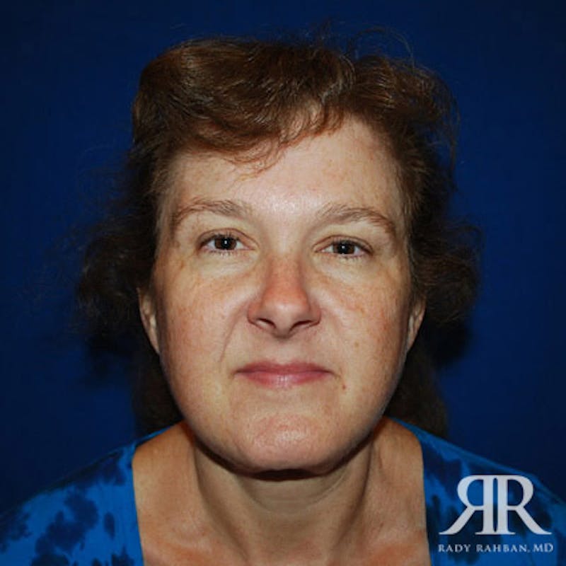 Facelift before photo