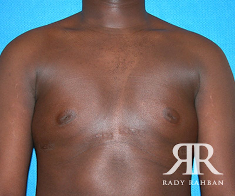 Gynecomastia result at Dr. Rady Rahban