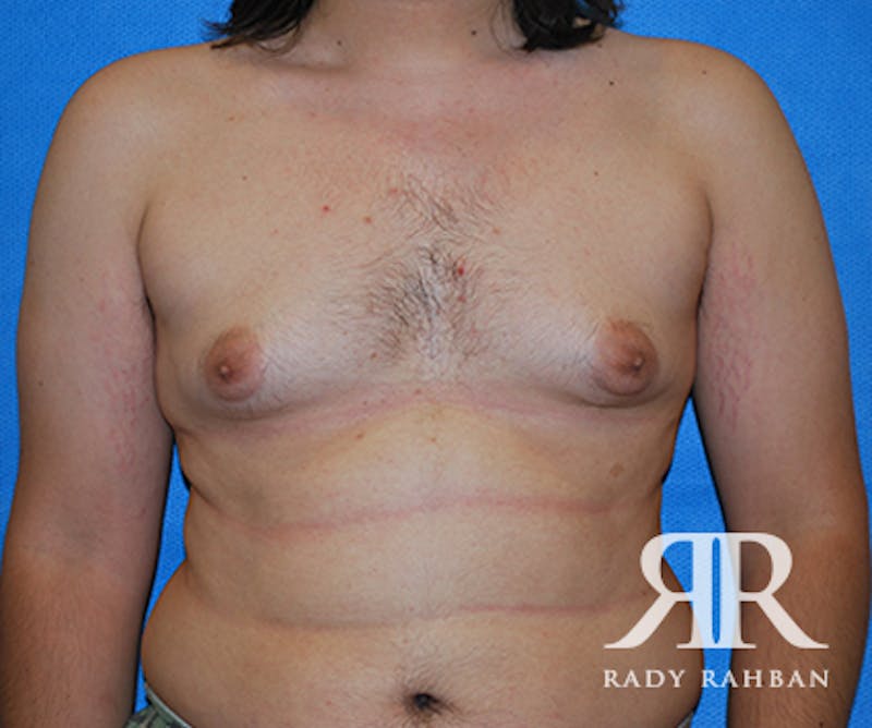 Gynecomastia before photo