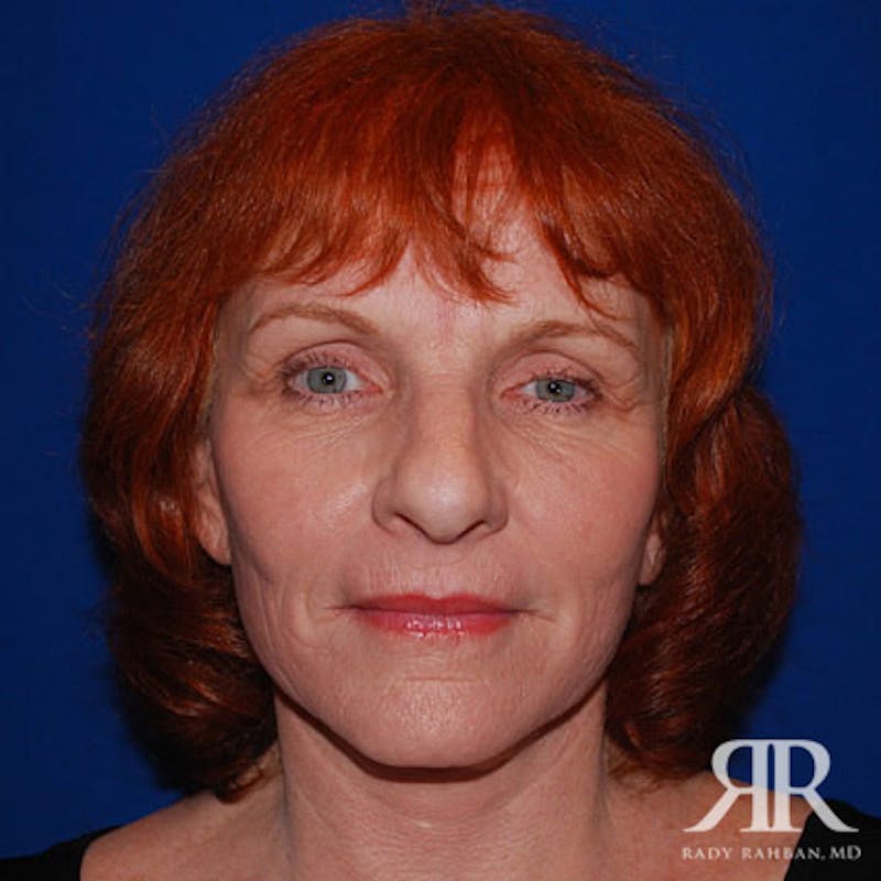 Facelift result at Dr. Rady Rahban