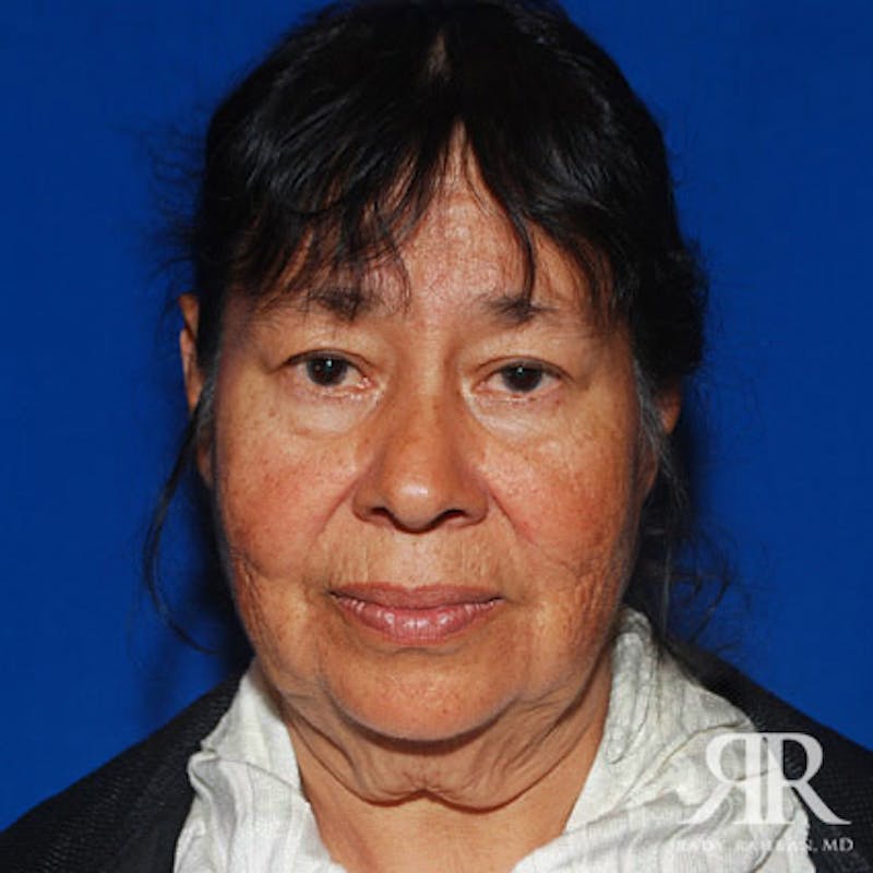 Facelift before photo