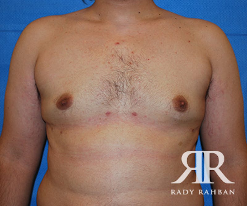 Gynecomastia result at Dr. Rady Rahban