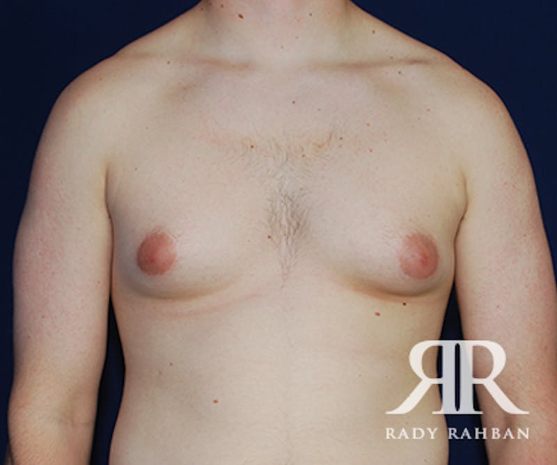 Gynecomastia before photo