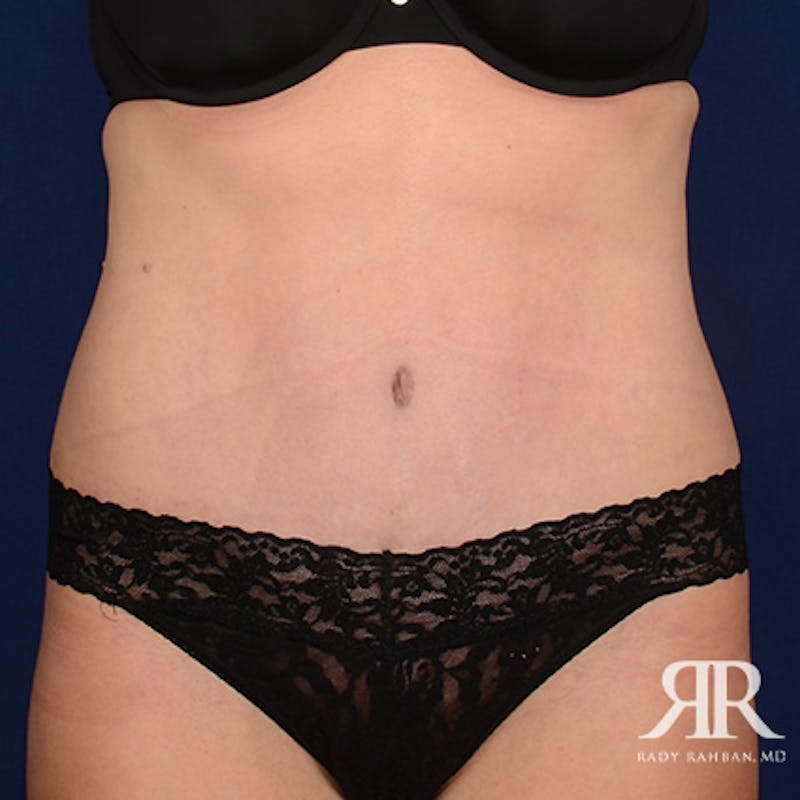 Tummy Tuck result at Dr. Rady Rahban