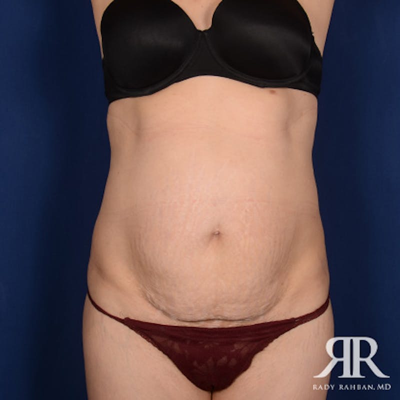 Tummy Tuck before photo