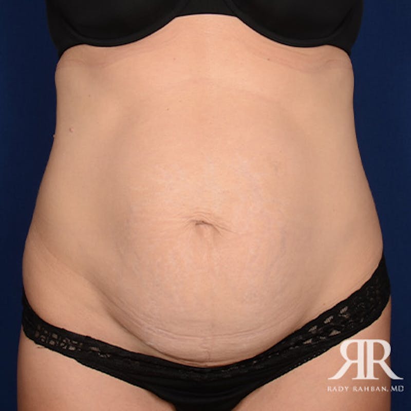 Tummy Tuck before photo