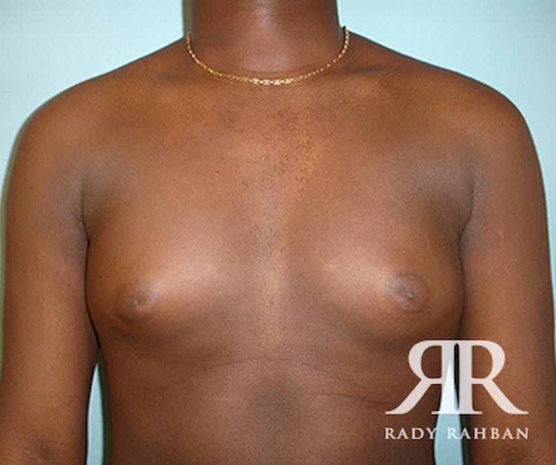 Gynecomastia before photo