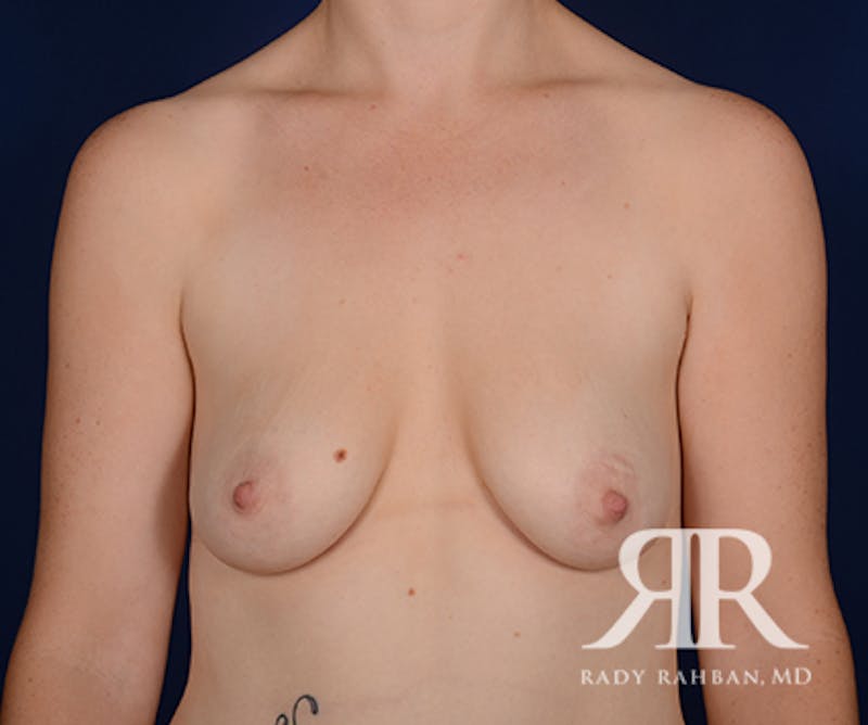 Breast Lift before photo