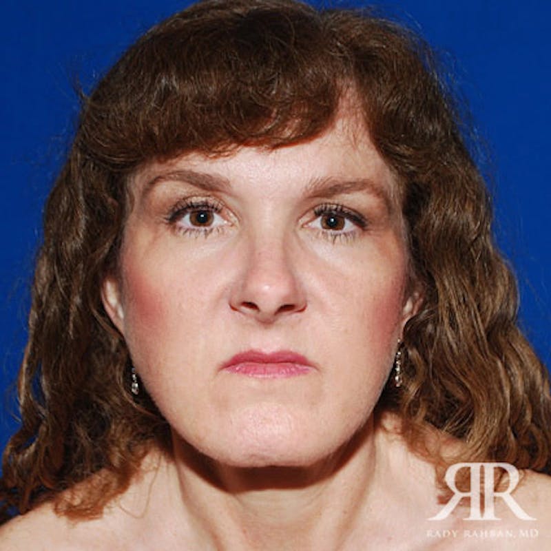 Facelift result at Dr. Rady Rahban