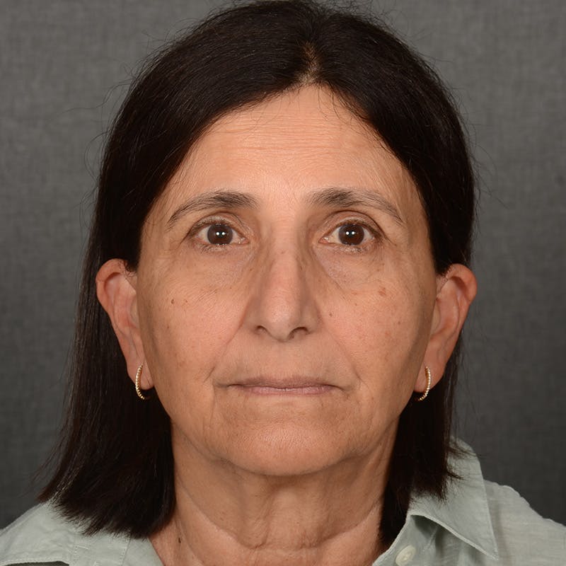 Facelift before photo