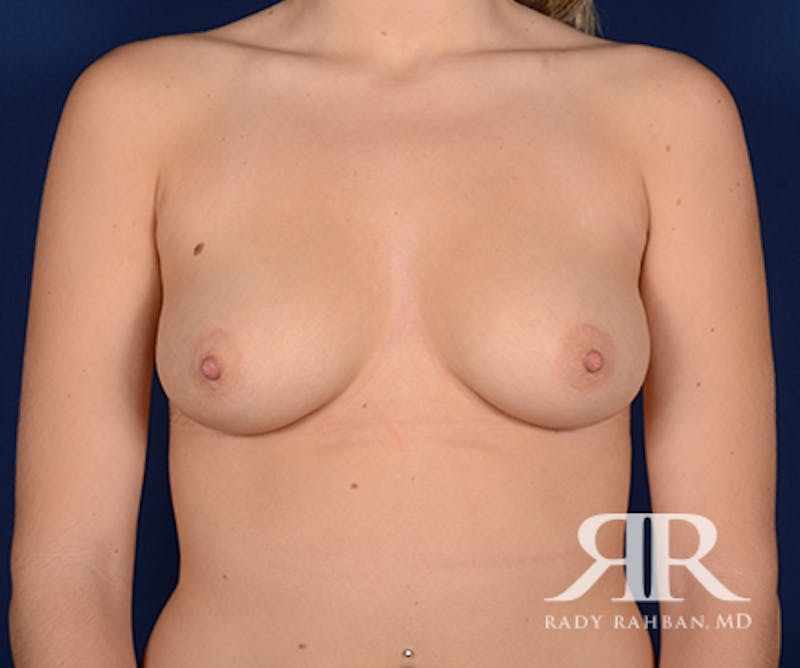 Breast Augmentation before photo