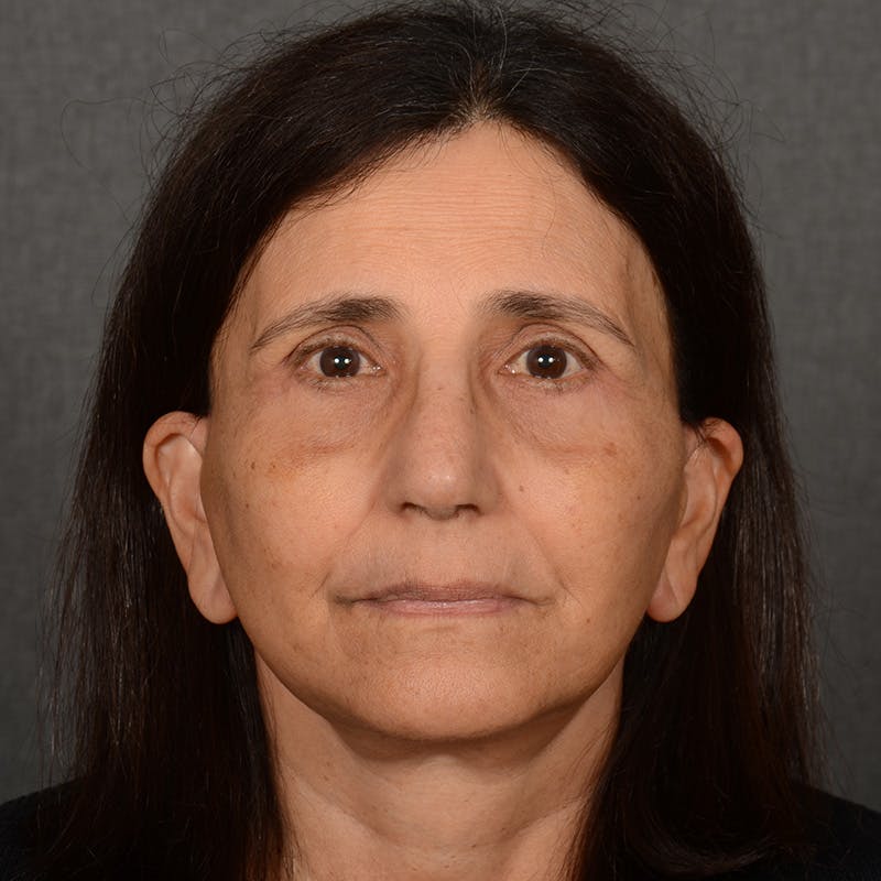 Facelift result at Dr. Rady Rahban