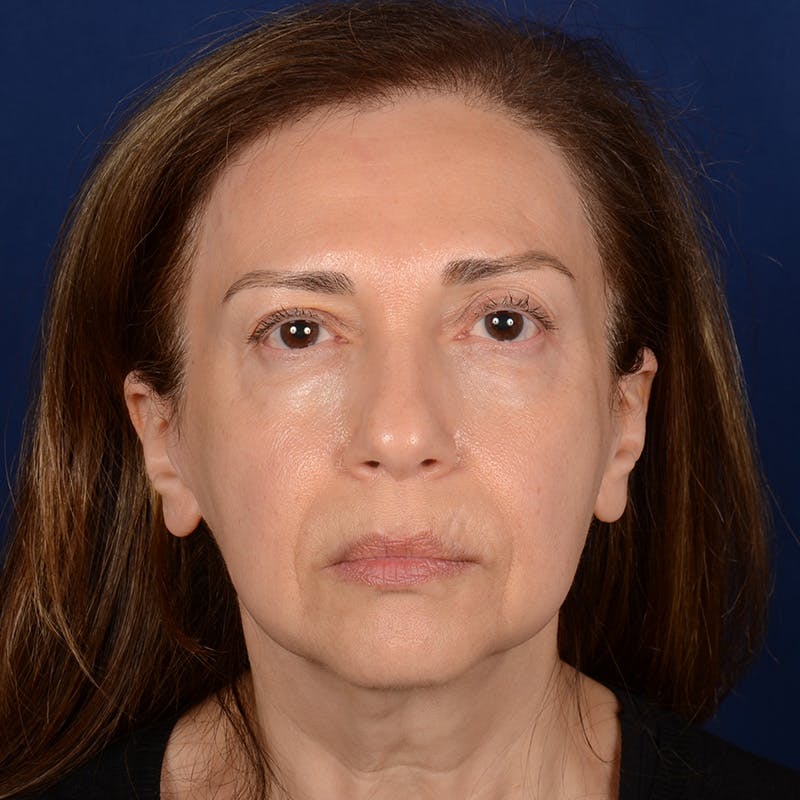 Facelift before photo