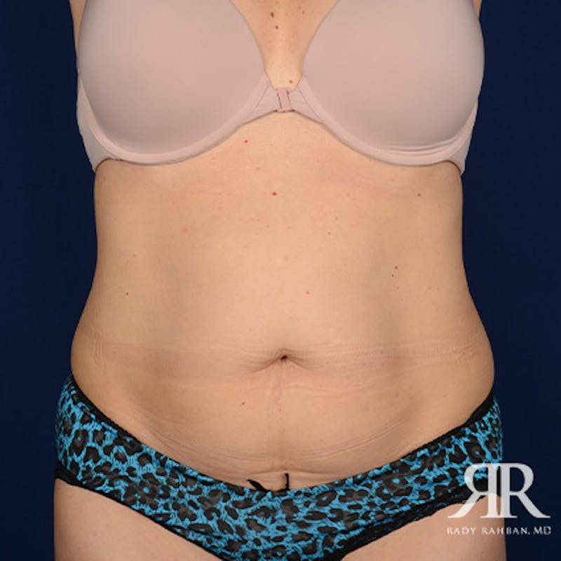 Tummy Tuck before photo