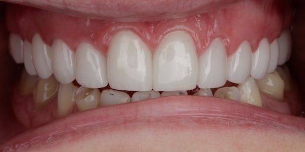 A result from Middle Tennessee Prosthodontics