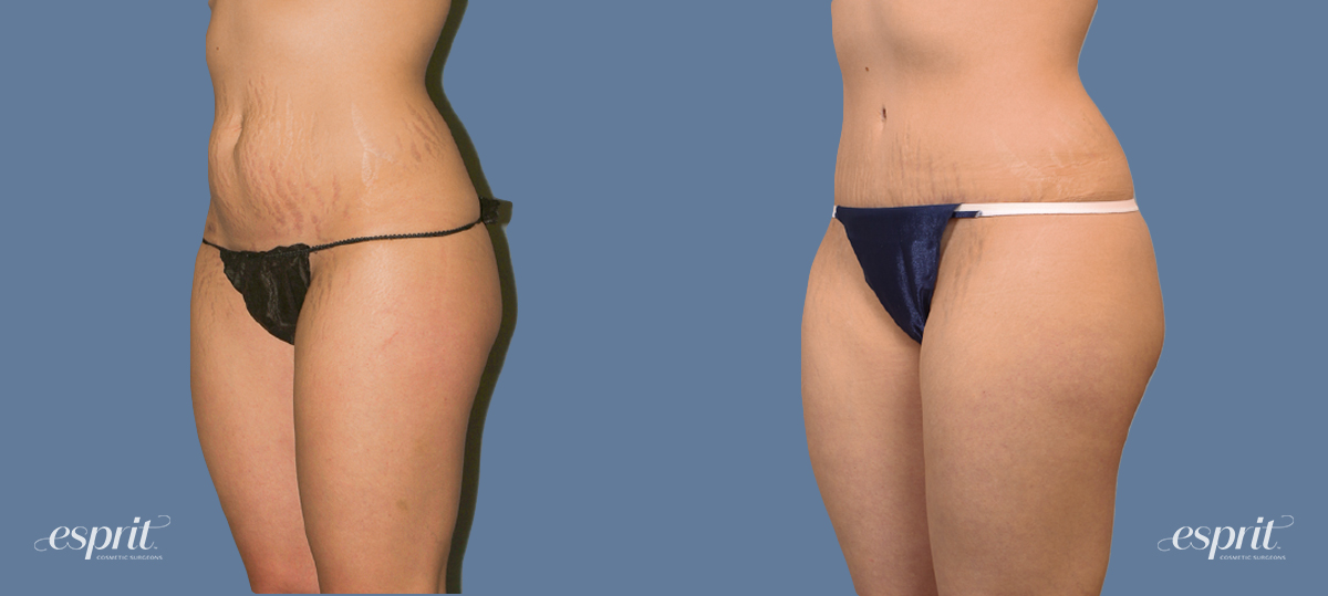 A result from Esprit Cosmetic Surgeons