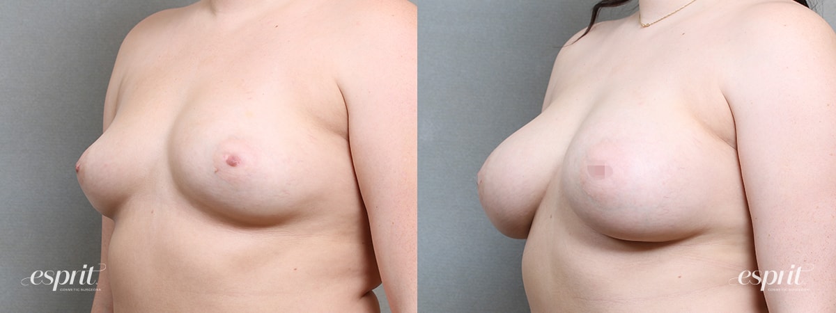 A result from Esprit Cosmetic Surgeons