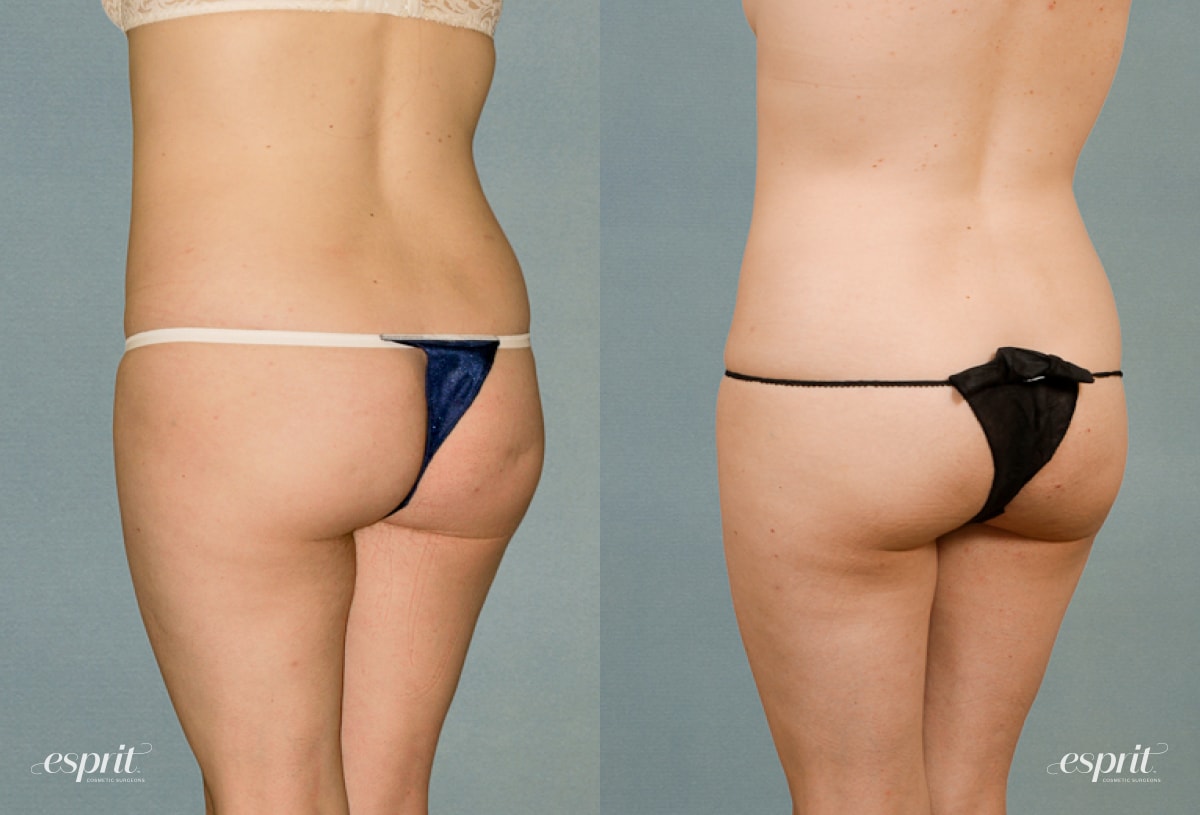 A result from Esprit Cosmetic Surgeons