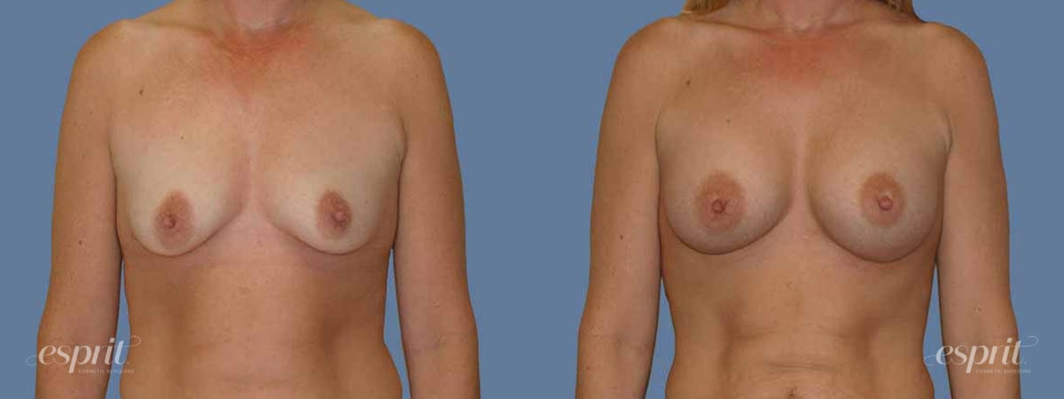 A result from Esprit Cosmetic Surgeons