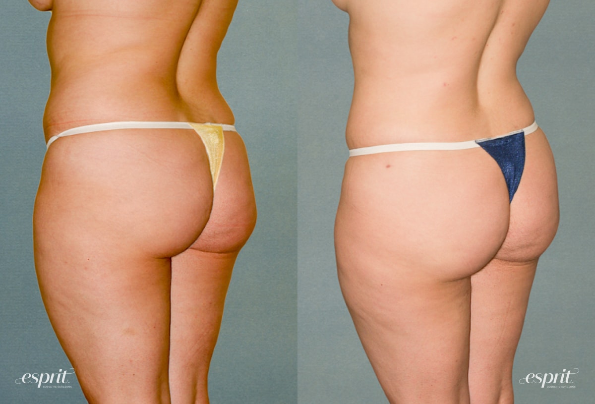 A result from Esprit Cosmetic Surgeons