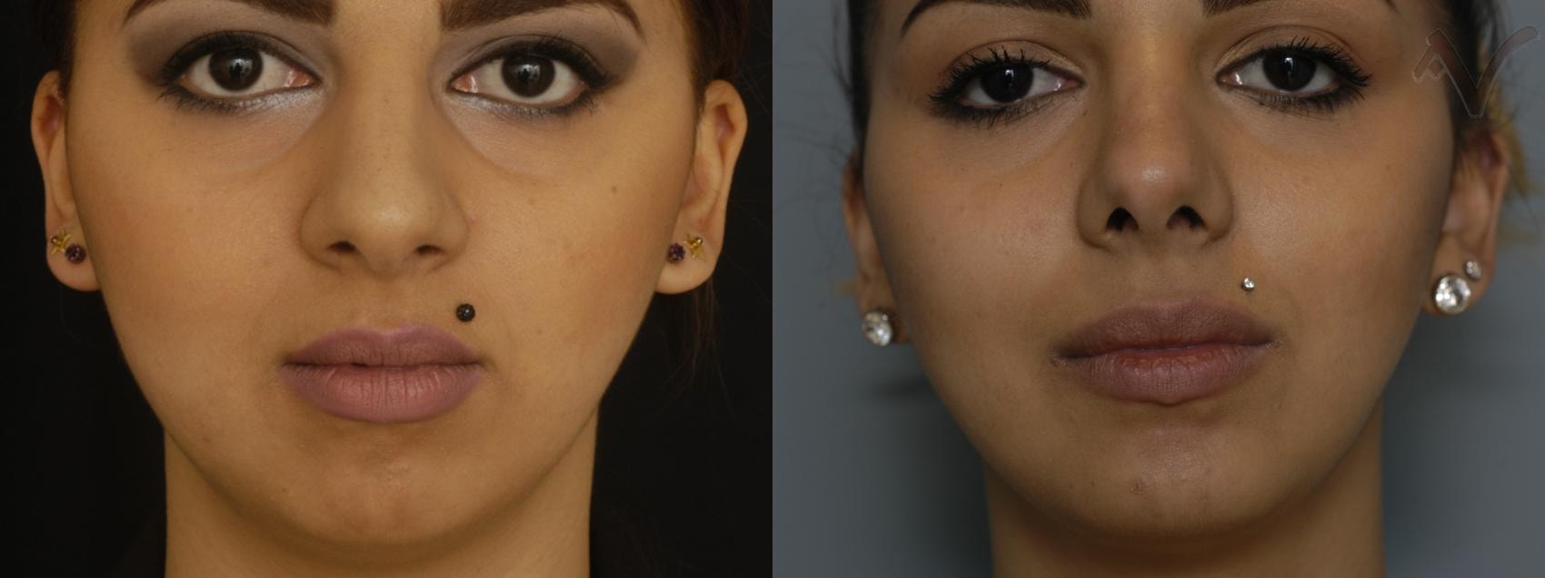A result from Armen Vartany, MD, FACS: Plastic Surgery and Laser Center