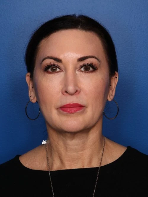 Blepharoplasty result at Howland Plastic Surgery