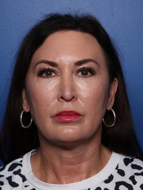 Blepharoplasty before photo