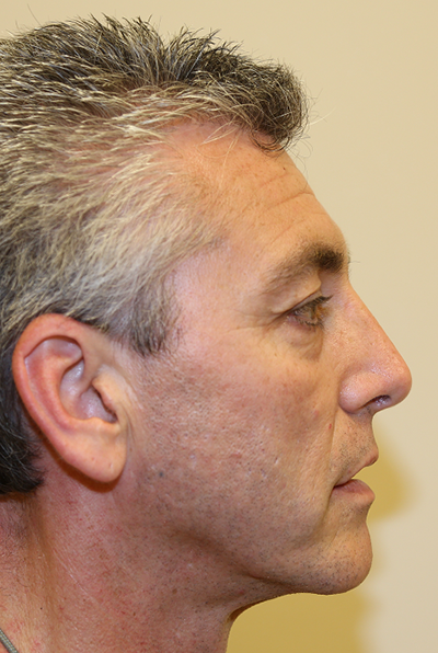 Michael J. Yoo, MD - Plastic Surgery after — Newport Beach, CA