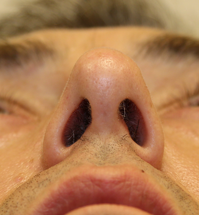 Procedure result at Michael J. Yoo, MD - Plastic Surgery