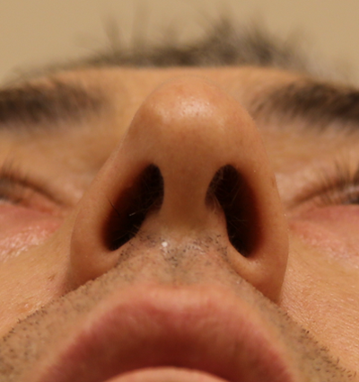 Procedure before photo