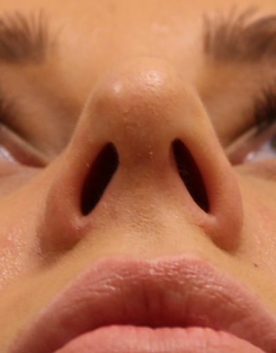 Procedure result at Michael J. Yoo, MD - Plastic Surgery