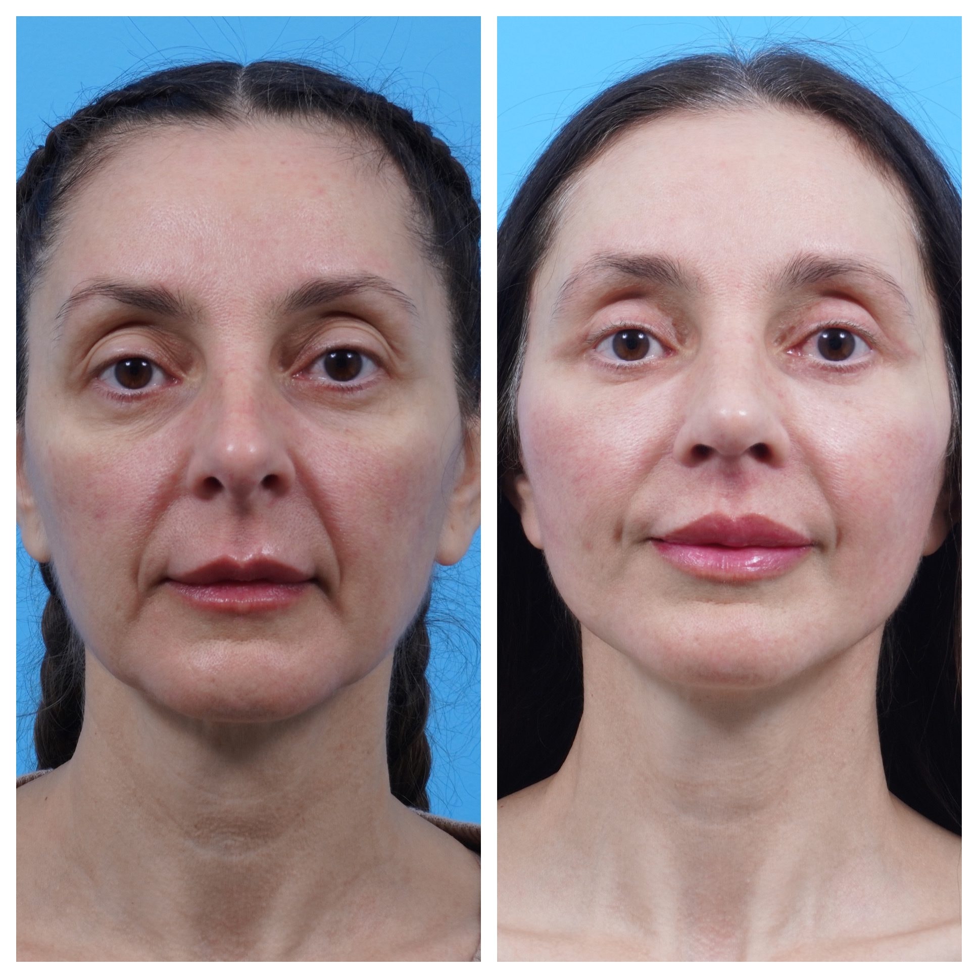 A result from Kismet Iorio Surgical Sculpting