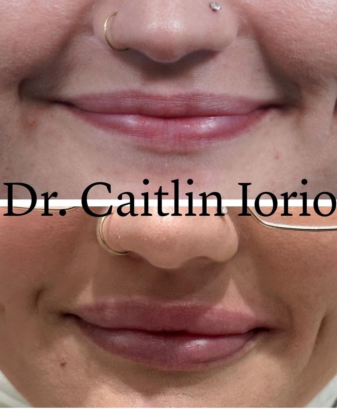 A result from Kismet Iorio Surgical Sculpting