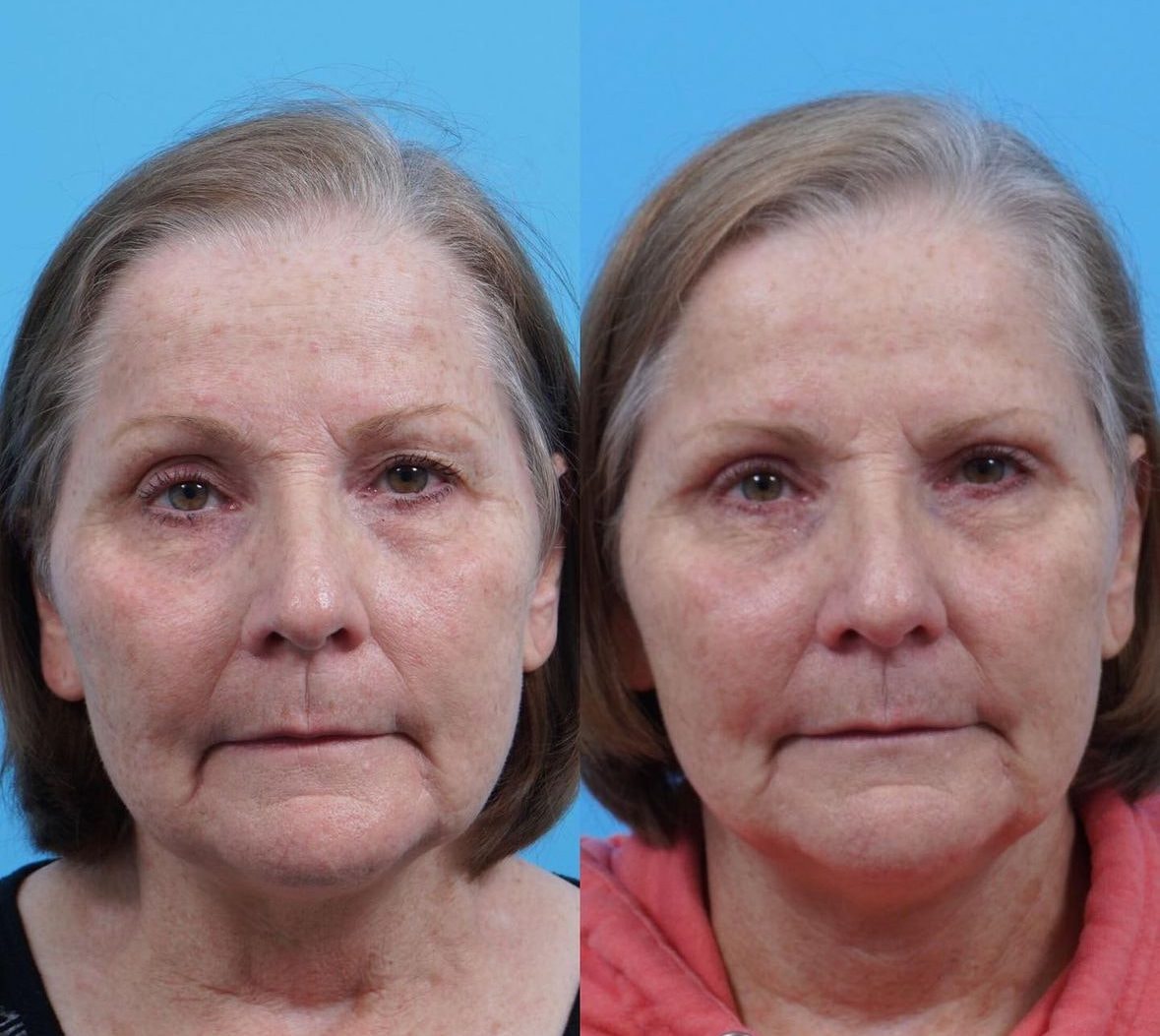 A result from Kismet Iorio Surgical Sculpting