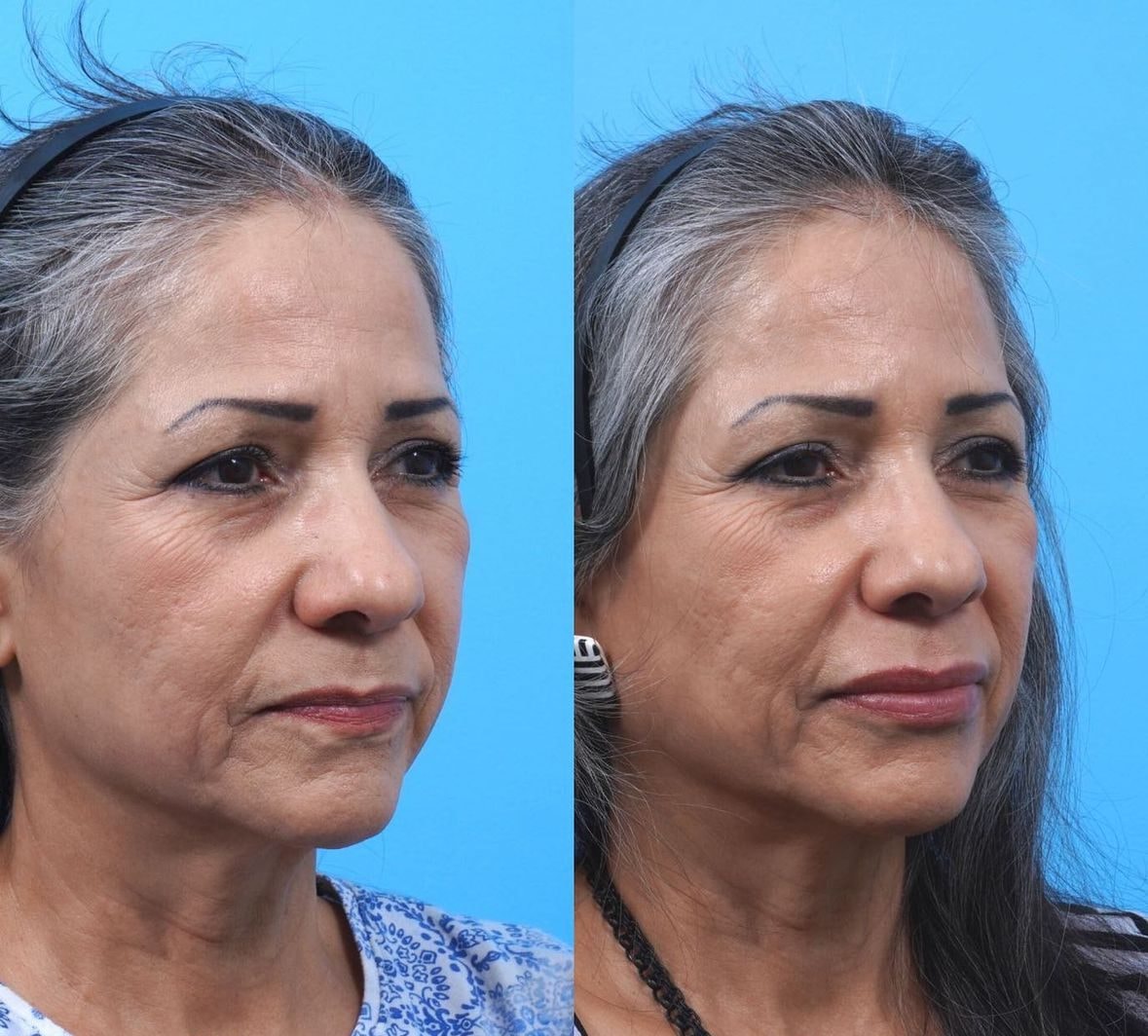 Brazilian Butt Lift before and after results