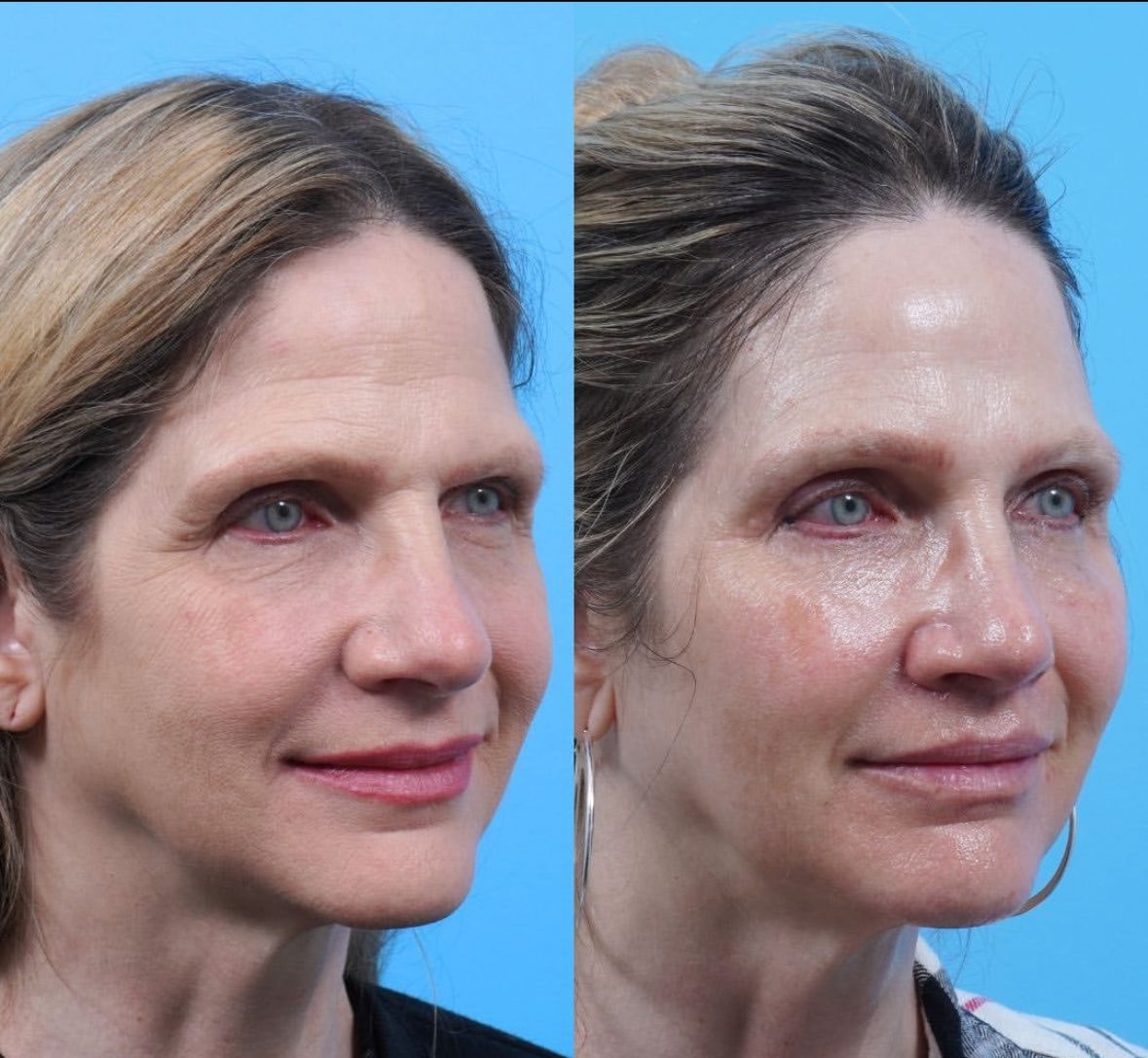 A result from Kismet Iorio Surgical Sculpting