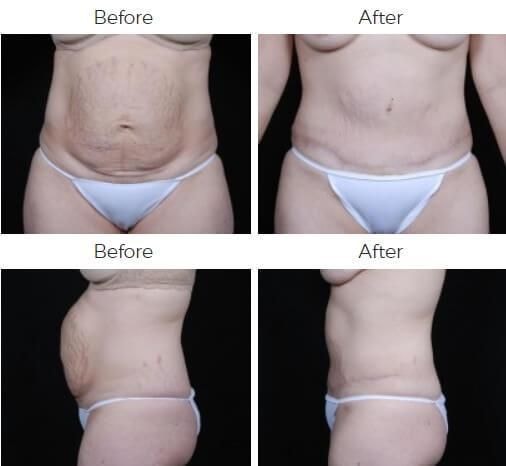 A result from Body By Bloch (Steven Bloch, MD)