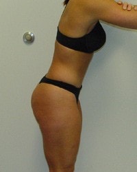 A result from Barrington Plastic Surgery (Gregory M. Bazell, MD)