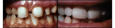 Sandy Center Family & Cosmetic Dentistry veneers result — Sandy, UT
