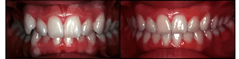 Sandy Center Family & Cosmetic Dentistry veneers result — Sandy, UT